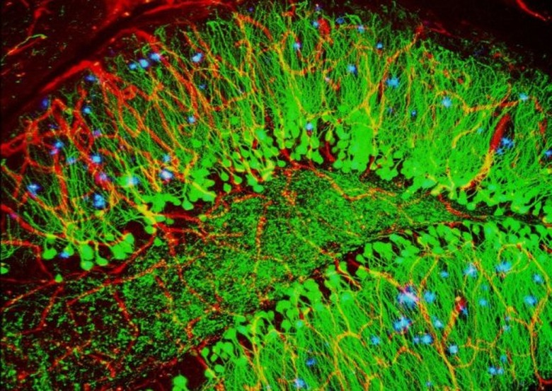 alzheimers-brain