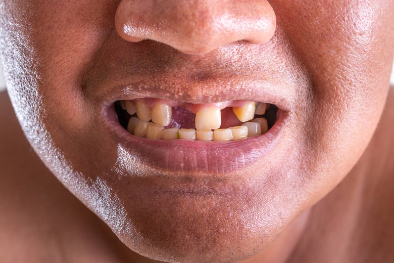 young man with missing teeth could benefit from tooth-regrowing drug