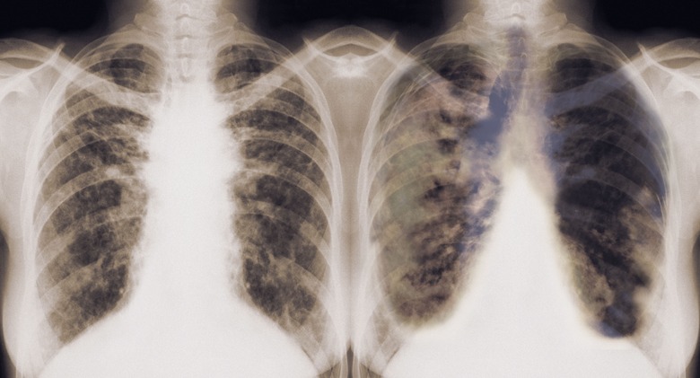 lungs, cancer