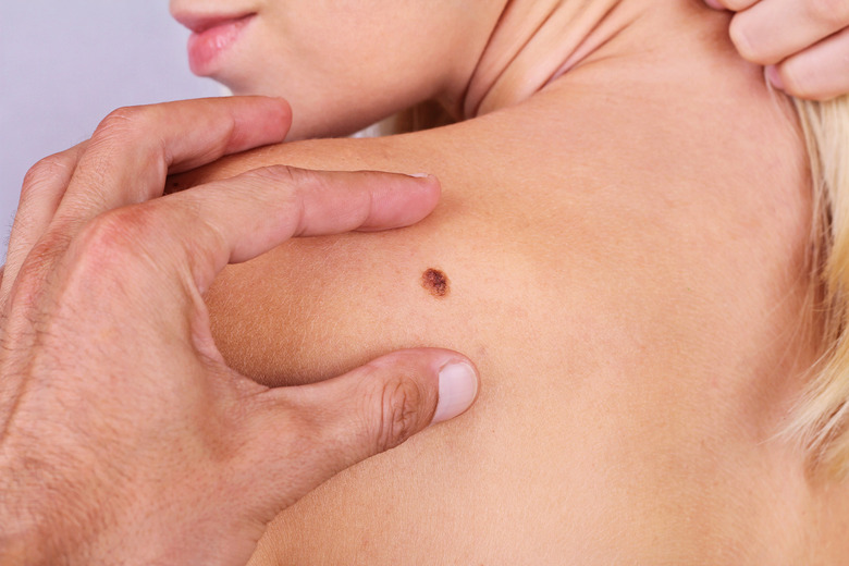 skin cancer could be cured with cancer-killing gel